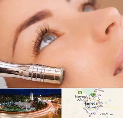 میکرودرم در همدان