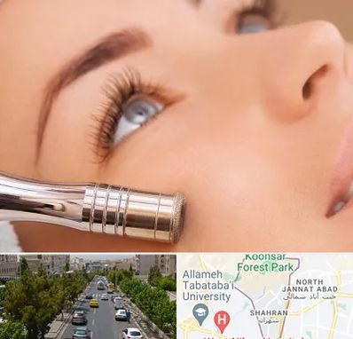 میکرودرم در شهران 