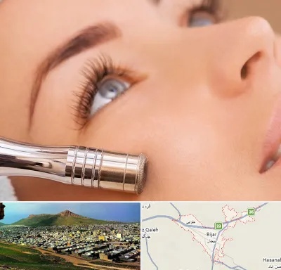 میکرودرم در بیجار