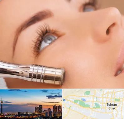 میکرودرم در غرب تهران 