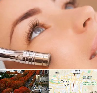 میکرودرم در ولیعصر 