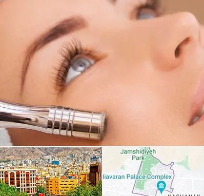 میکرودرم در نیاوران 