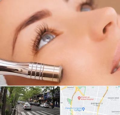 میکرودرم در ظفر 