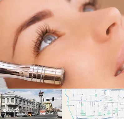 میکرودرم در 17شهریور