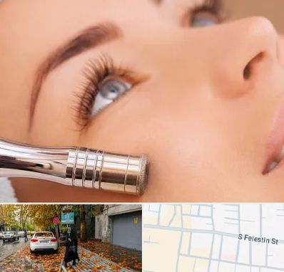 میکرودرم در خیابان فلسطین