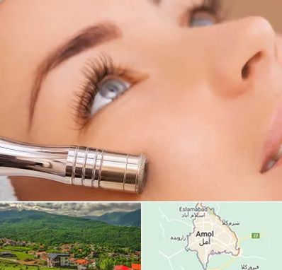 میکرودرم در آمل