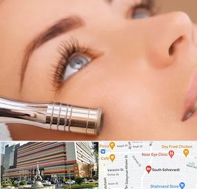 میکرودرم در سهروردی 