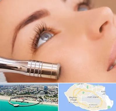 میکرودرم در کیش