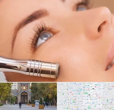 میکرودرم در منطقه 12 تهران 