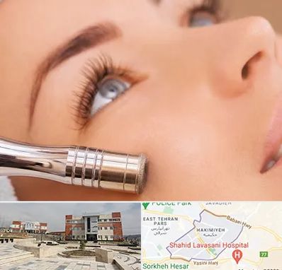 میکرودرم در حکیمیه 