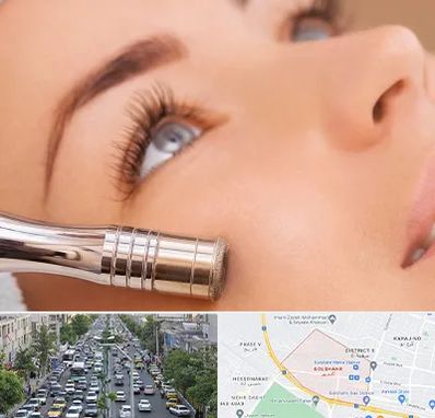 میکرودرم در گلشهر کرج