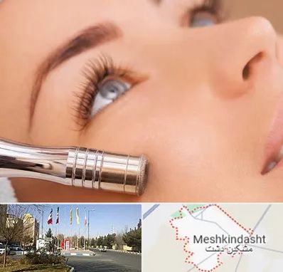 میکرودرم در مشکین دشت