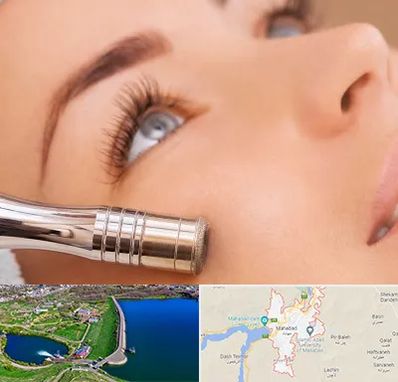 میکرودرم در مهاباد