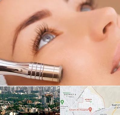 میکرودرم در عظیمیه کرج 