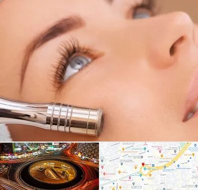 میکرودرم در میدان ولیعصر 