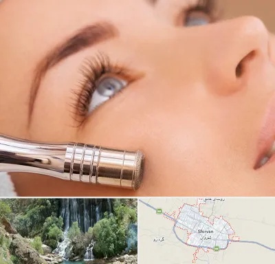 میکرودرم در شیروان