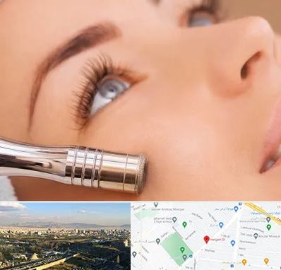 میکرودرم در هنگام 