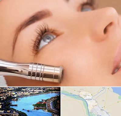 میکرودرم در خرمشهر