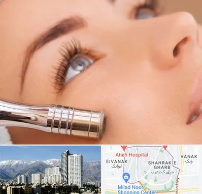 میکرودرم در شهرک غرب 