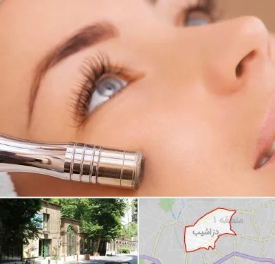 میکرودرم در دزاشیب