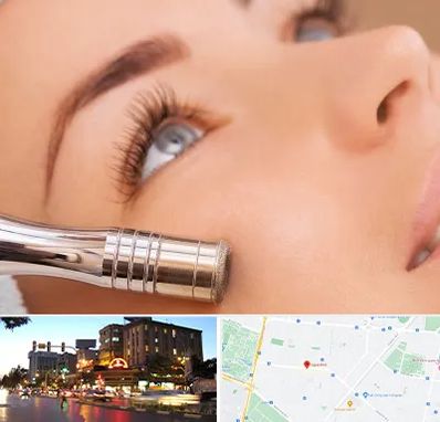 میکرودرم در بلوار سجاد مشهد