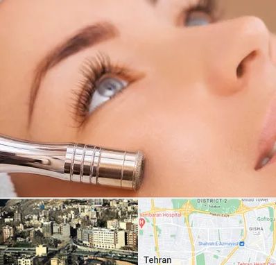 میکرودرم در مرزداران 