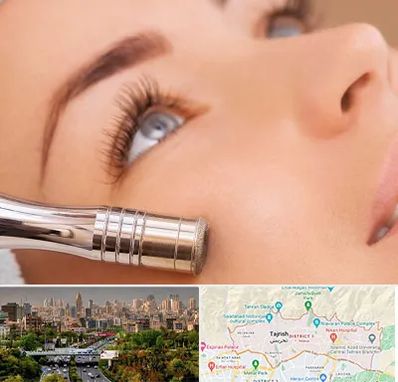 میکرودرم در منطقه 1 تهران 