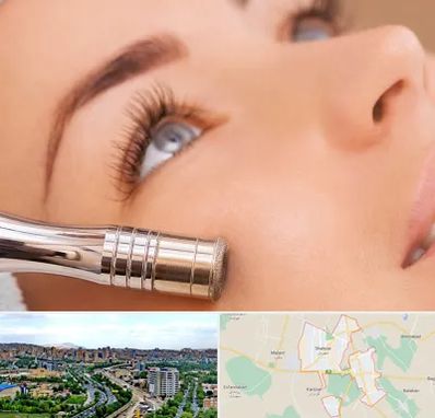 میکرودرم در شهریار