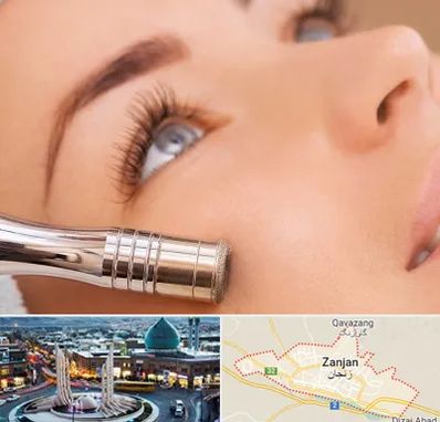 میکرودرم در زنجان