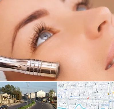 میکرودرم در ضیابری رشت