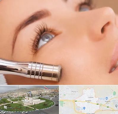 میکرودرم در بومهن