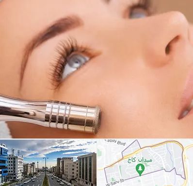 میکرودرم در سعادت آباد 