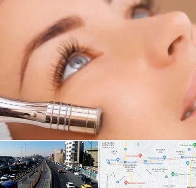 میکرودرم در پیروزی 