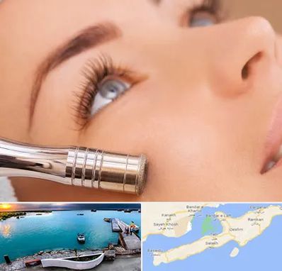 میکرودرم در قشم