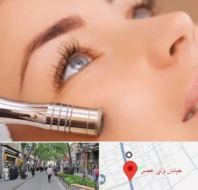 میکرودرم در ولیعصر شهریار