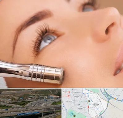 میکرودرم در یاغچیان تبریز