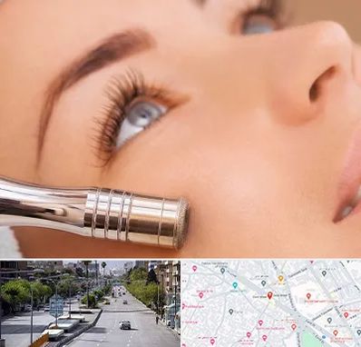 میکرودرم در خیابان زند شیراز