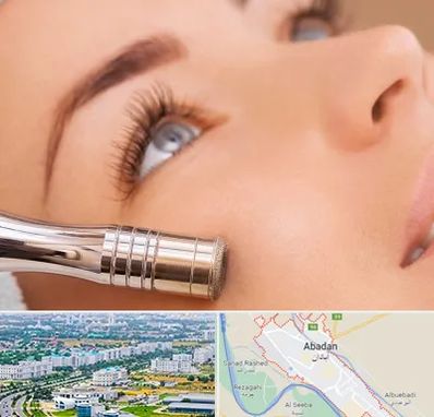میکرودرم در آبادان