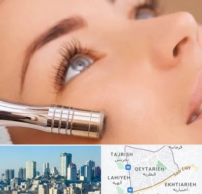 میکرودرم در قیطریه 