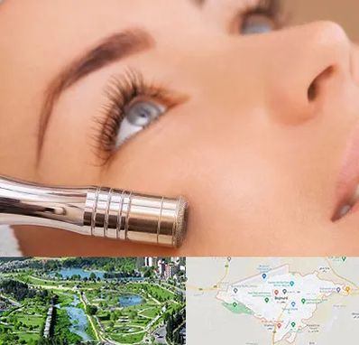 میکرودرم در بجنورد