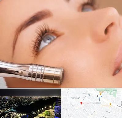 میکرودرم در هفت تیر مشهد