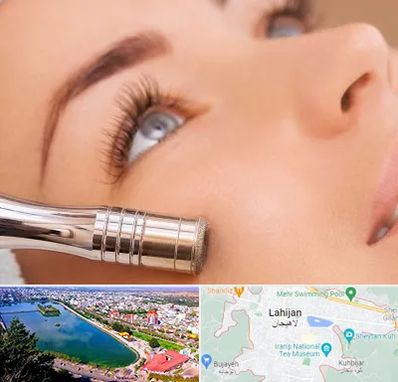 میکرودرم در لاهیجان