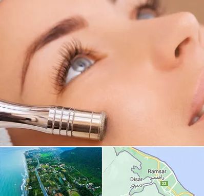 میکرودرم در رامسر