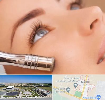 میکرودرم در ملارد