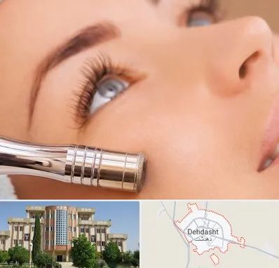 میکرودرم در دهدشت