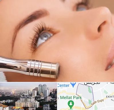 میکرودرم در الهیه 