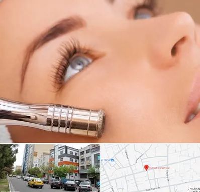 میکرودرم در هفده شهریور تبریز