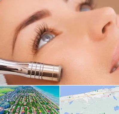 میکرودرم در فریدونکنار