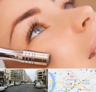 میکرودرم در زیتون کارمندی اهواز