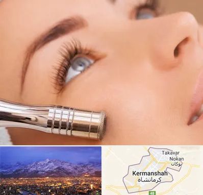 میکرودرم در کرمانشاه